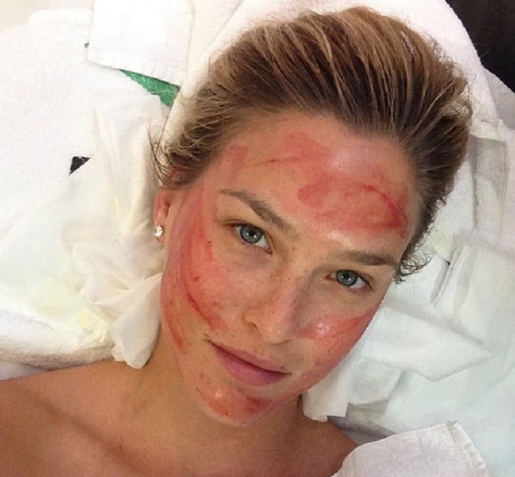 Bar Refaeli Vampire Facial