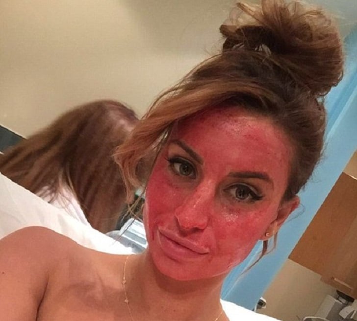 Ferne McCann Vampire Facial