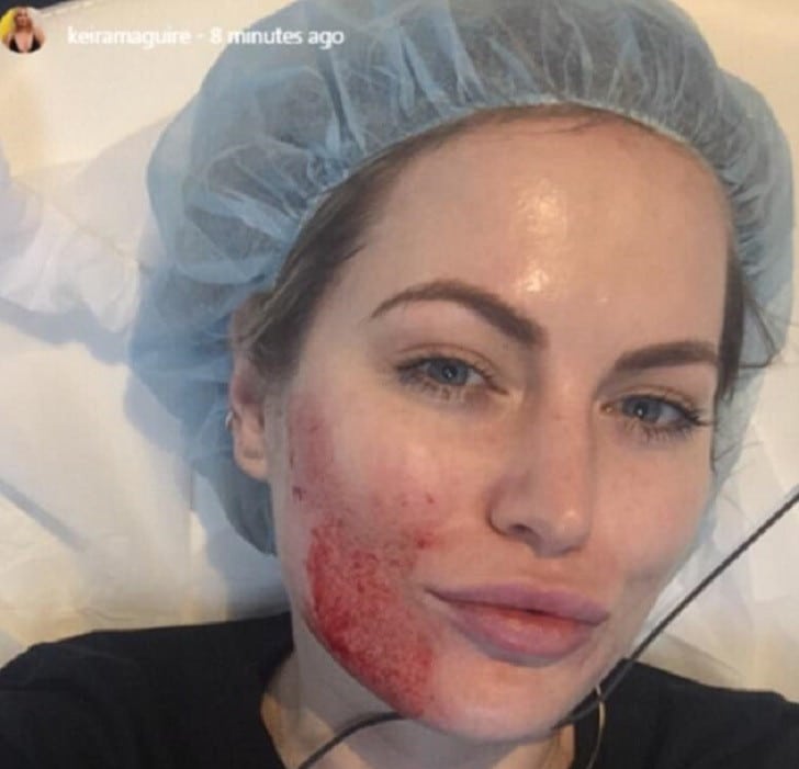 Keira Maguire Vampire Facial