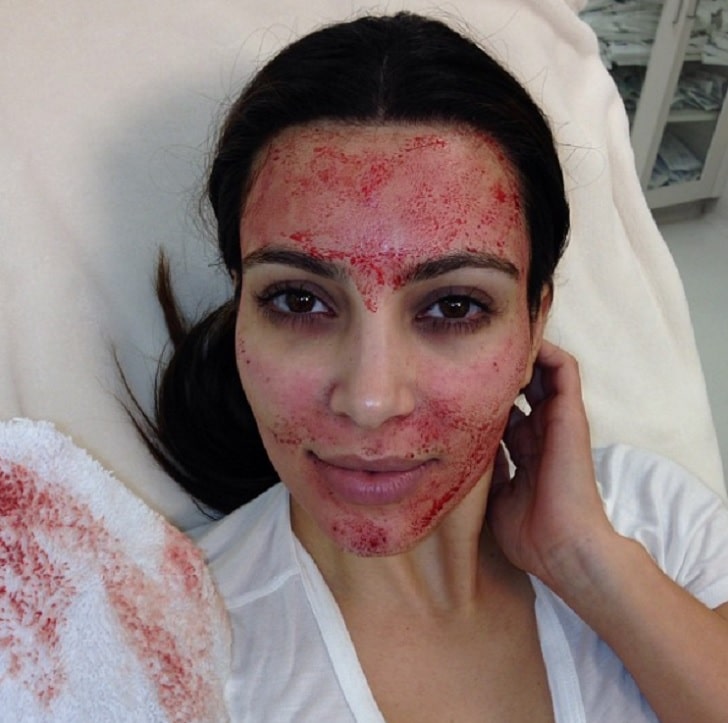 Kim Kardashian Vampire Facial