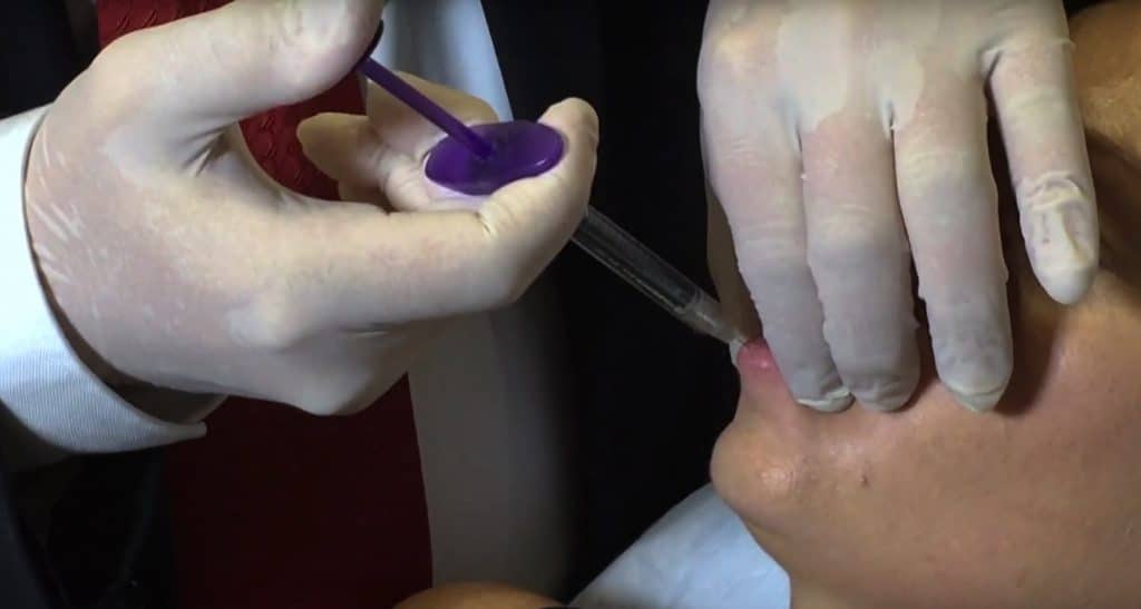 Lip Filler Vobella by Dr Beldholm