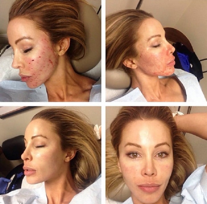 Lisa Hochstein Vampire Facial