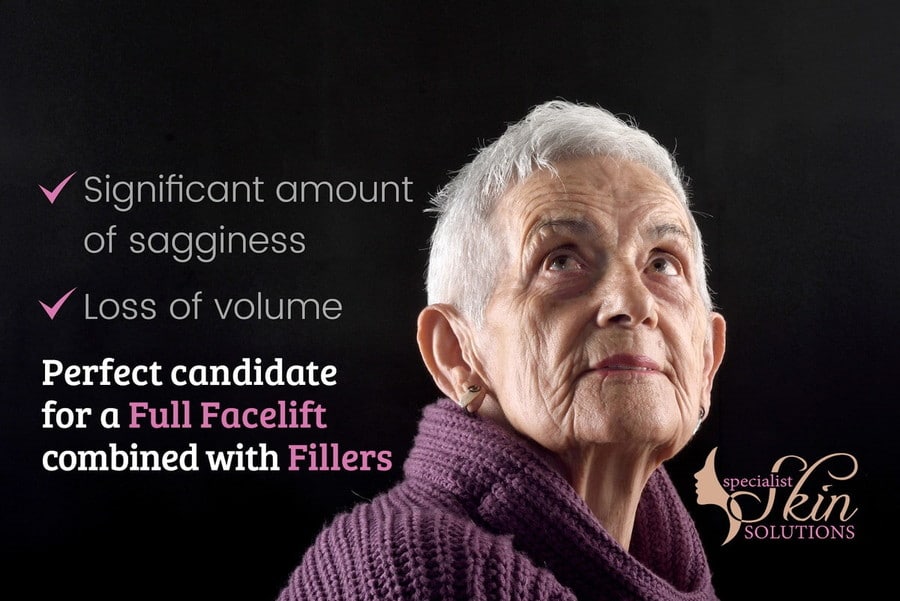 Perfect Candidate for Full Facelift