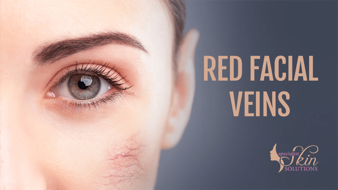 Get Rid Red Facial Veins by Dr Bernard Beldholm