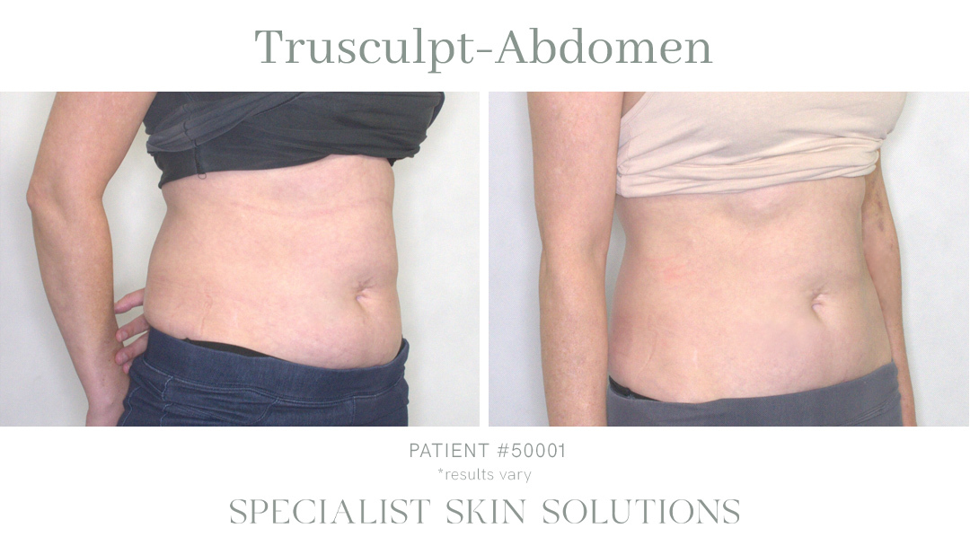 Trusculpt Abdomen Angle