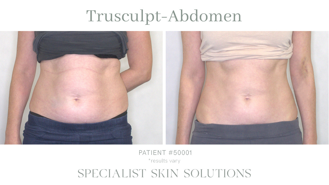 Trusculpt Abdomen Front