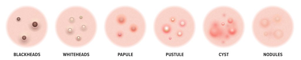 Acne Stages - Specialist Skin Solutions