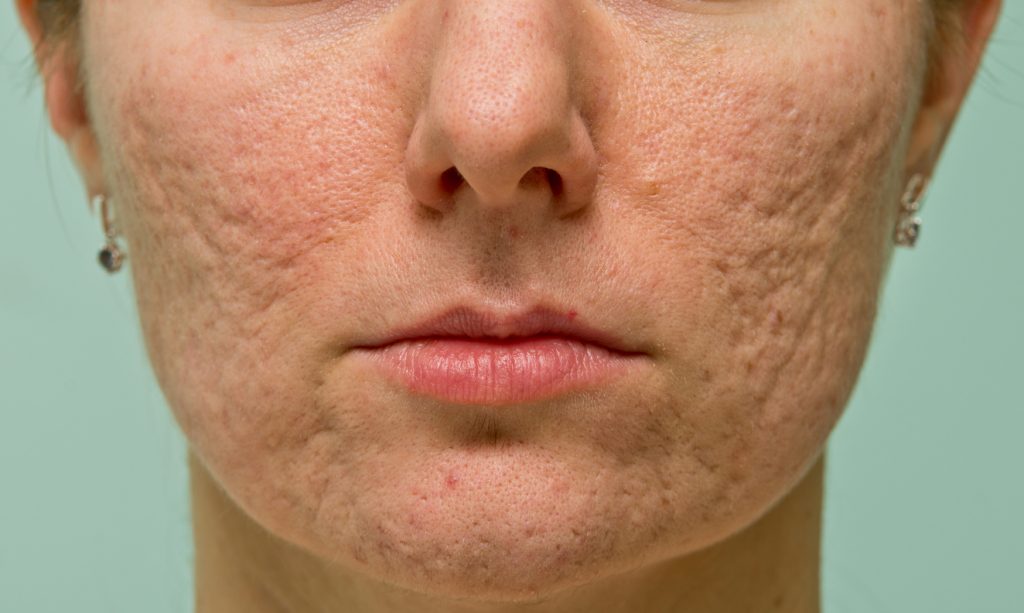 Acne Scar Treatment - Specialist Skin Solutions
