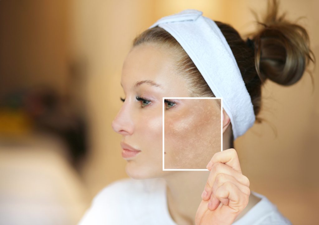 Melasma Treatment - Specialist Skin Solutions
