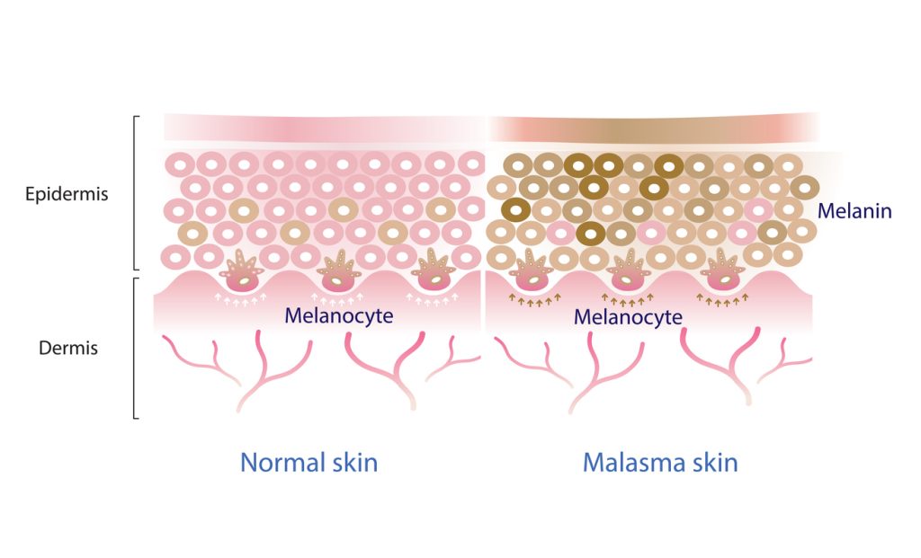 Normal vs Melasma Skin - Specialist Skin Solutions