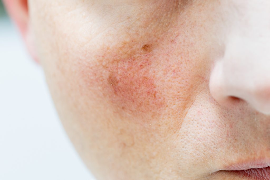 Our treatment for broken capillaries - Specialist Skin Solutions