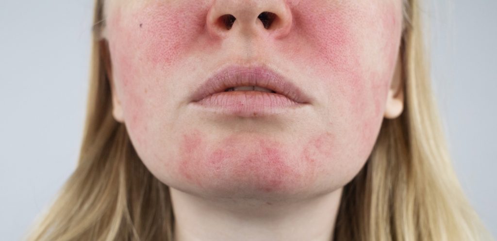 Rosacea - Specialist Skin Solutions