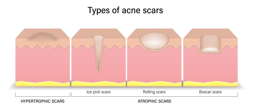Type of Acne Scars - Specialist Skin Solutions