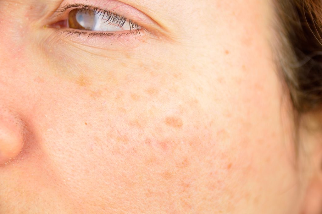 What causes age spots - Specialist Skin Solutions