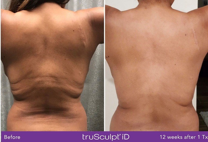 Trusculpt eliminates entire fat layer.