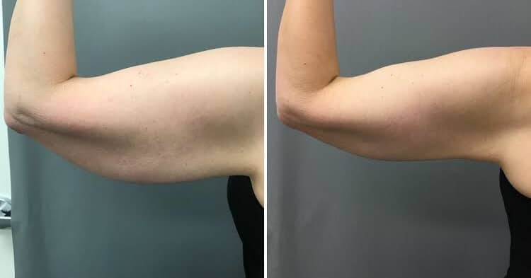 Arms are a treatment area for radiofrequency  lipolysis 