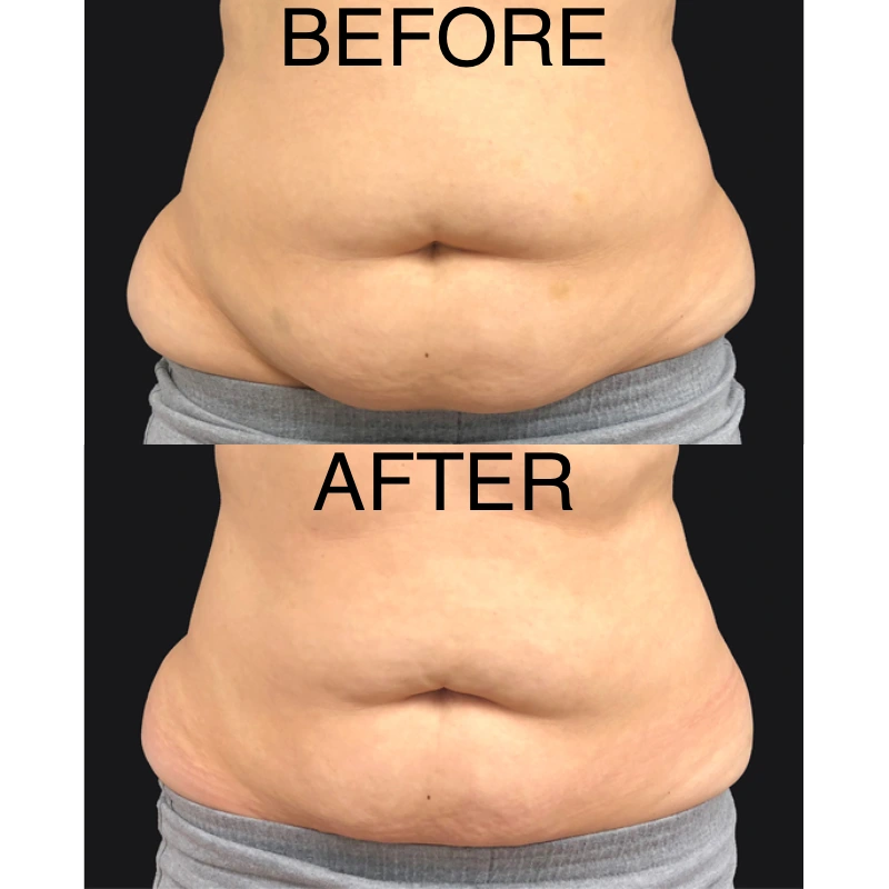 Nonsurgical body contouring treatment  