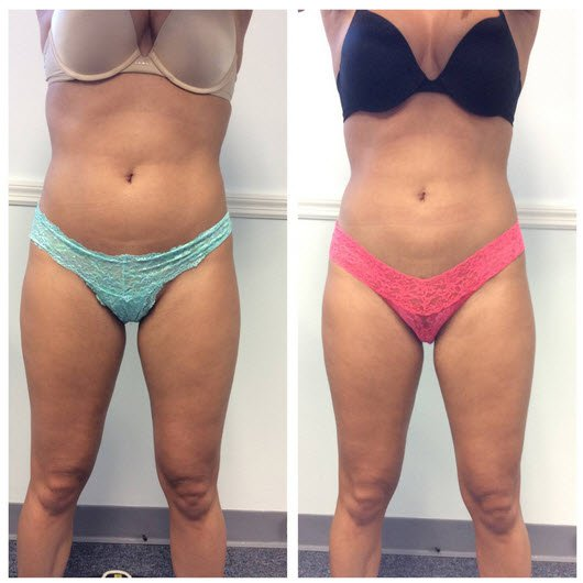 Before and after TruSculpt abdomen and flanks. 