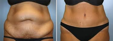 Surgery for patients with high body mass index