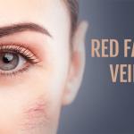 Get Rid Red Facial Veins by Dr Bernard Beldholm